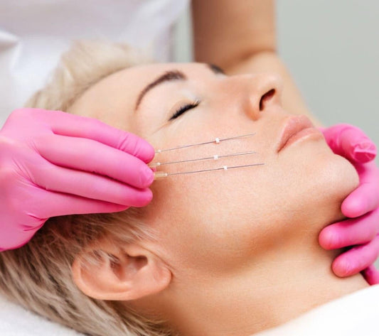 woman receiving Aptos thread lift treatment on her face