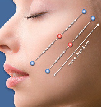 Silhouette Soft® Thread Lift